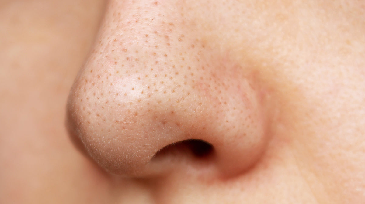 Enlarged nose pores close up