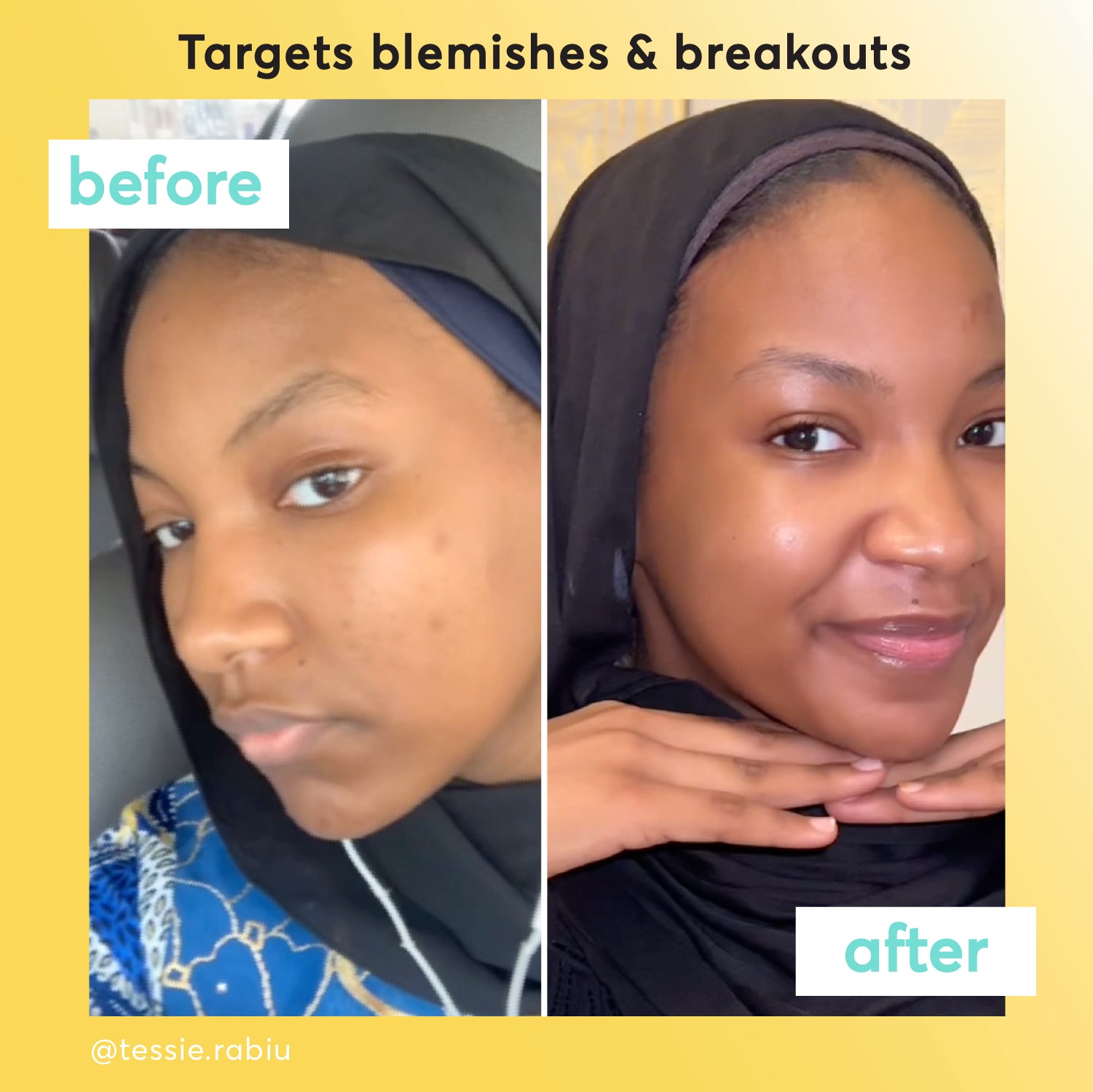 Before and after comparison of @tessie.rabiu using the Clear Skin Range.